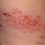 Shingles