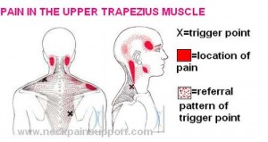 trigger point referral from trapezius 